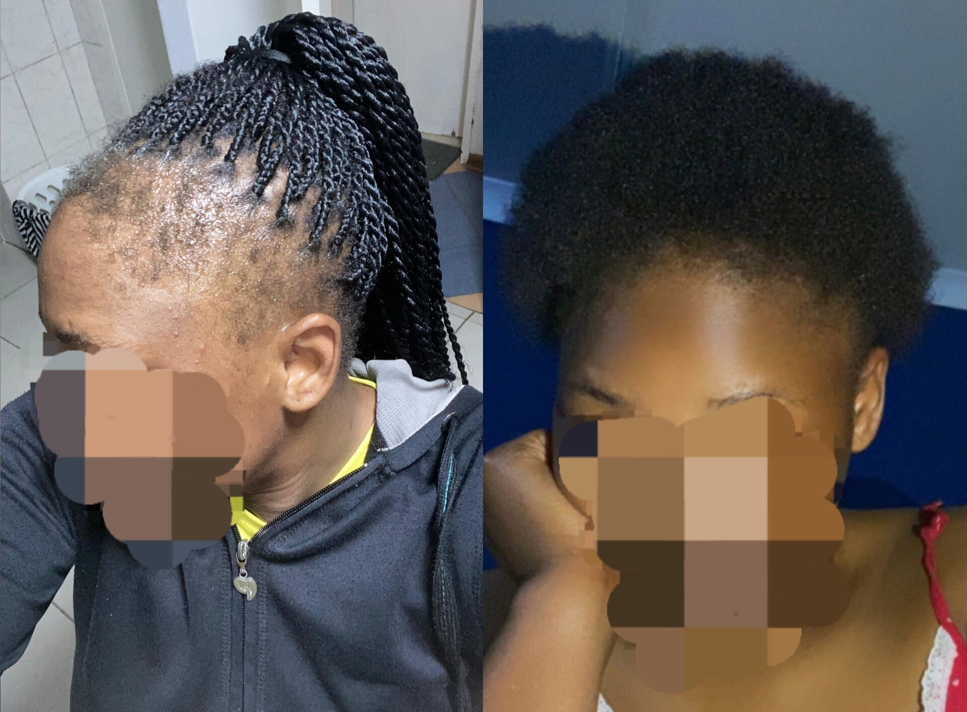 Hairline Restoration